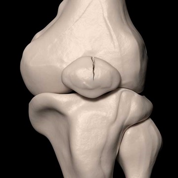 kneecap fracture 3d