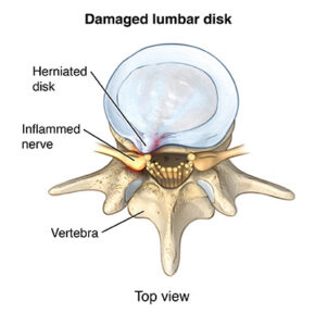 lumbarradiculopathyherniateddisc