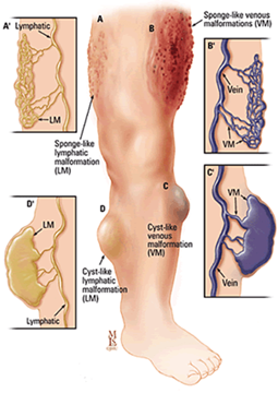 Illustratsioon, mis näitab mitut tüüpi vaskulaarseid väärarenguid jalas, sealhulgas lümfisüsteemi ja venoosseid väärarenguid.