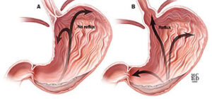 mechanismofgastroesophagealrefluxdisease290412