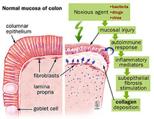 mechanismofinjuryincollagenouscolitis290489