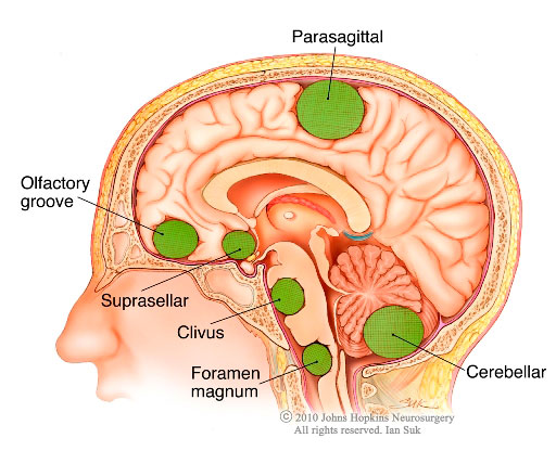 Diagramm, mis näitab teatud meningioomide asukohta