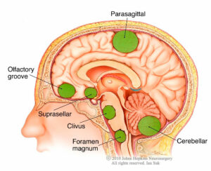 meningiomaiansuk.ashx