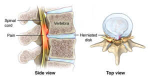 myelopathydiagram.ashx