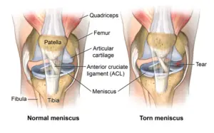 normal and torn meniscus