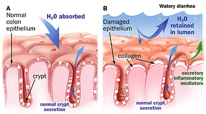Kõhulahtisuse patogenees kollageense ja lümfotsüütilise koliidi korral;  A: normaalne epiteel;  B: kahjustatud epiteel.