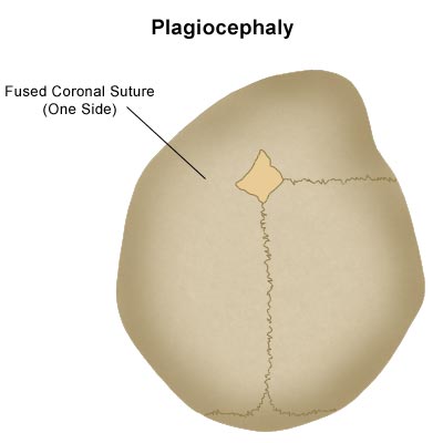 Plagiotsefaaliaga beebi pea skeem, millel on ühel küljel sulatatud koronaalõmblus.