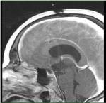 Kraniofarüngioomi MRI külgvaates pärast orbitosügomaatilist kraniotoomiat
