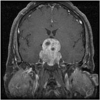 preopnonfunctionalmacroadenoma1