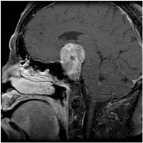 MRI-s nähtud suur hüpofüüsi adenoom enne operatsiooni