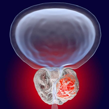 prostatetumor