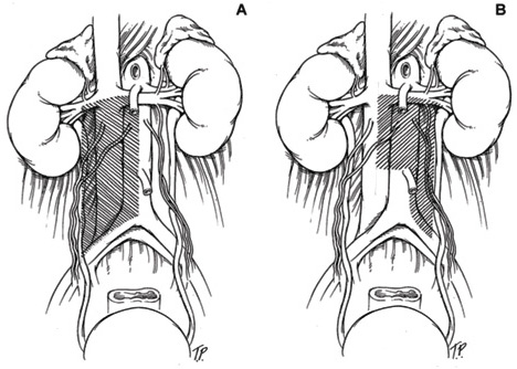 Kahe erineva dissektsioonimeetodi illustratsioon