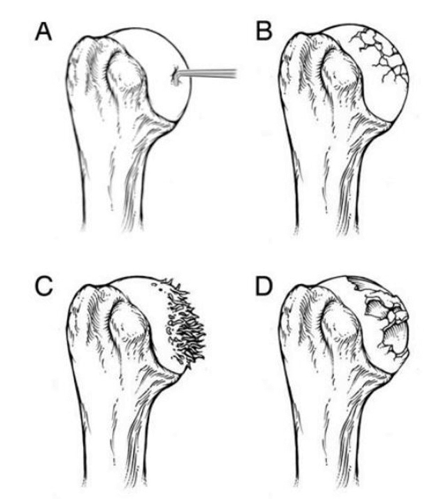 Õla artriidi neli etappi