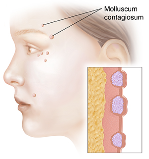 Naise näo külgvaade, millel on molluscum contagiosum.  Inset näitab molluscum contagiosum'i ristlõiget.