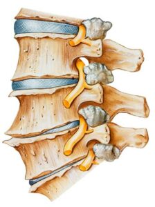 spinalarthritis.ashx