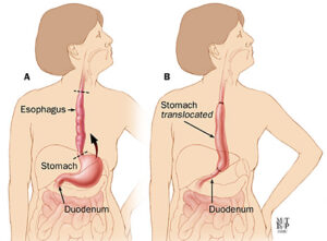 techniquefortranshiatalesophagectomyaremovaloftheesophagusbtr