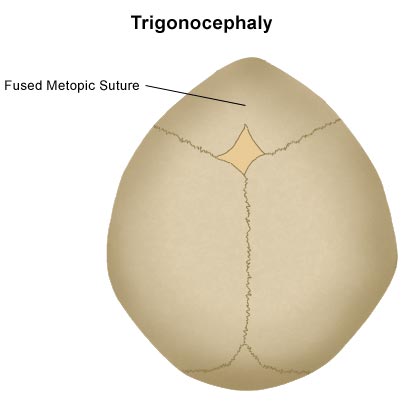 Trigonotsefaaliaga beebi pea skeem, millel on kujutatud kokkusulanud metoopilist õmblust.