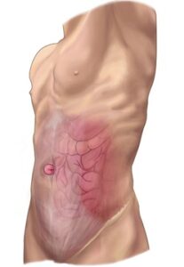 umbilicalhernia